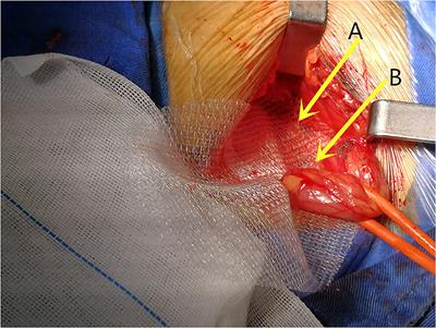 Long-Term Follow-Up of Lichtenstein Repair of Inguinal Hernia in the Morbid Patients With Self-Gripping Mesh (ProgripTM)